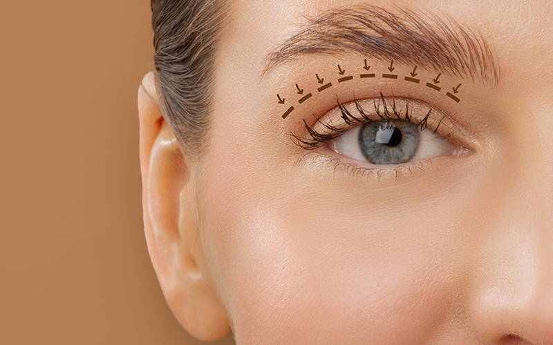 Göz Kapağı Estetiği (Blefaroplasti)